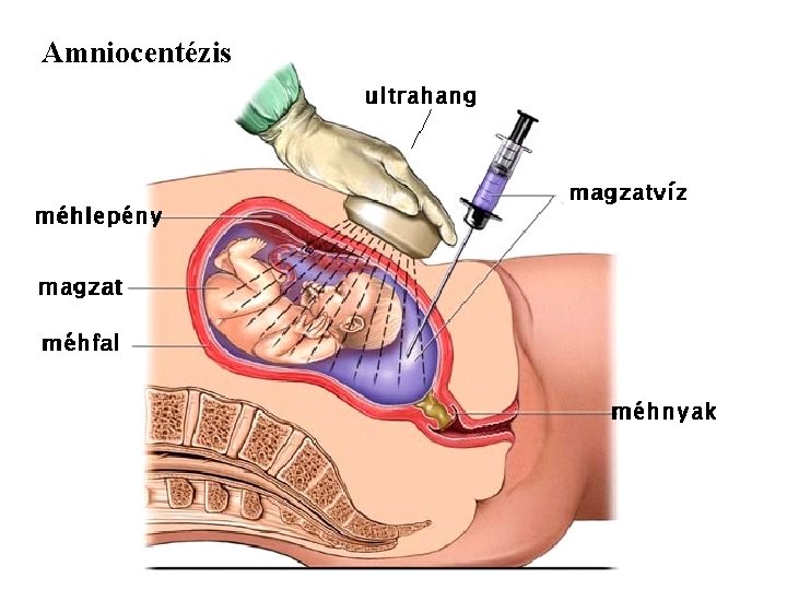 Amniocentézis 