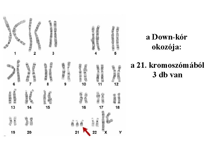 a Down-kór okozója: a 21. kromoszómából 3 db van 