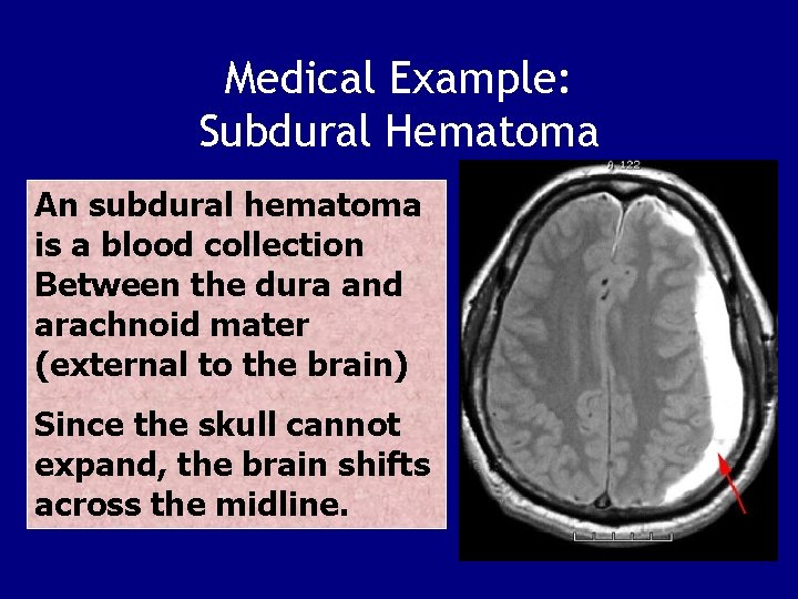 Medical Example: Subdural Hematoma An subdural hematoma is a blood collection Between the dura