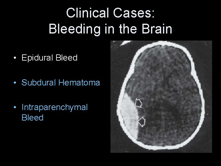 Clinical Cases: Bleeding in the Brain • Epidural Bleed • Subdural Hematoma • Intraparenchymal