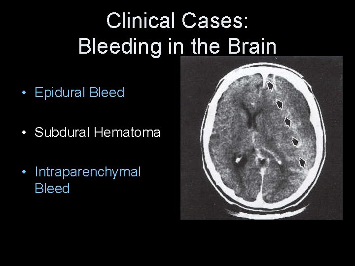 Clinical Cases: Bleeding in the Brain • Epidural Bleed • Subdural Hematoma • Intraparenchymal