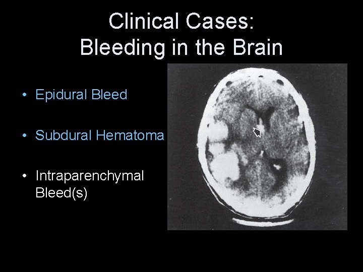 Clinical Cases: Bleeding in the Brain • Epidural Bleed • Subdural Hematoma • Intraparenchymal