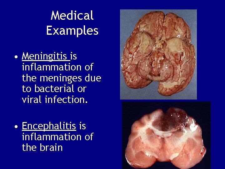 Medical Examples • Meningitis is inflammation of the meninges due to bacterial or viral