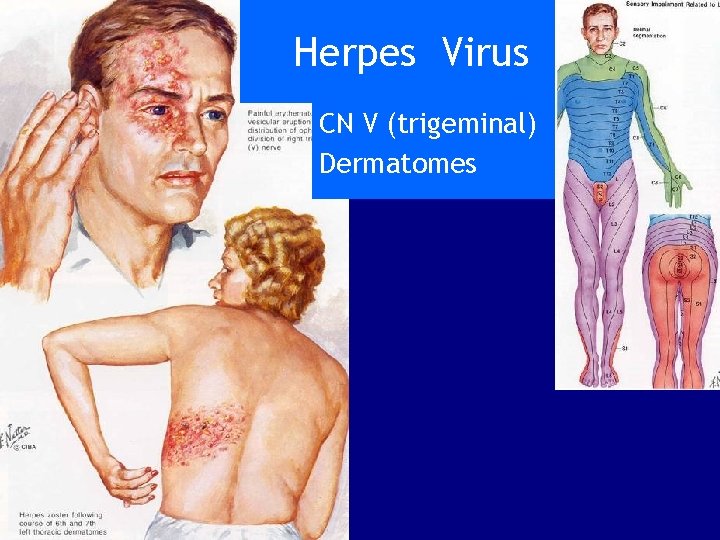 Herpes Virus CN V (trigeminal) Dermatomes 