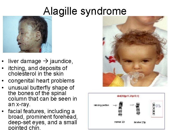 Alagille syndrome • liver damage jaundice, • itching, and deposits of cholesterol in the