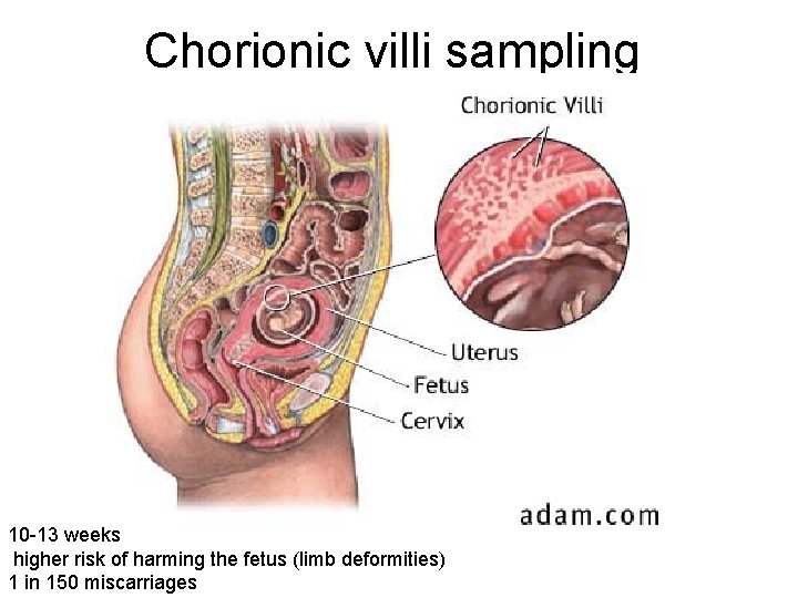 Chorionic villi sampling 10 -13 weeks higher risk of harming the fetus (limb deformities)