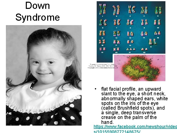 Down Syndrome • flat facial profile, an upward slant to the eye, a short