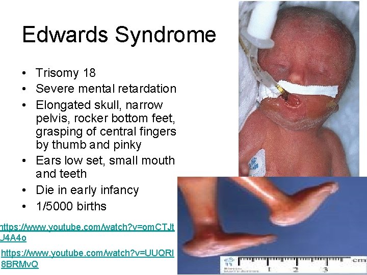 Edwards Syndrome • Trisomy 18 • Severe mental retardation • Elongated skull, narrow pelvis,
