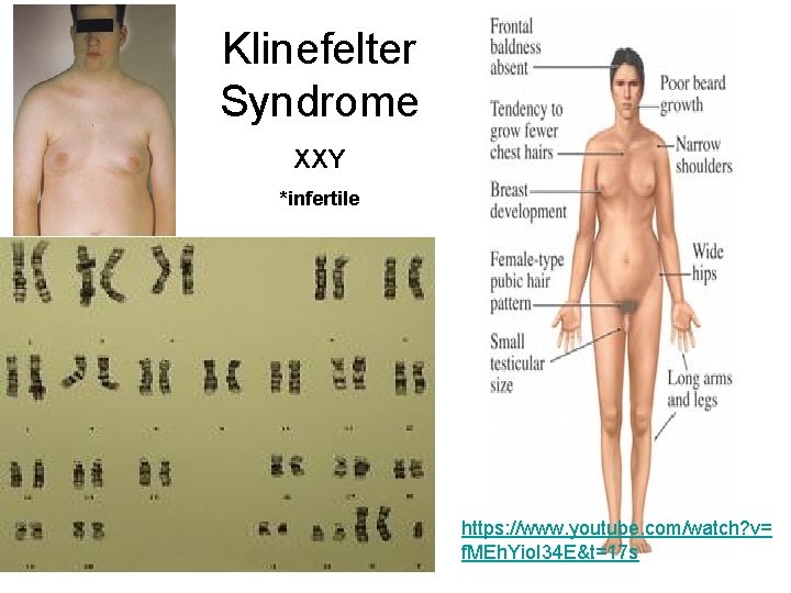 Klinefelter Syndrome XXY *infertile https: //www. youtube. com/watch? v= f. MEh. Yio. I 34