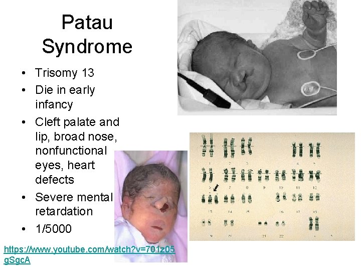 Patau Syndrome • Trisomy 13 • Die in early infancy • Cleft palate and