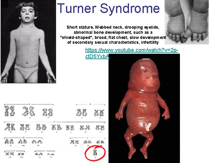 Turner Syndrome Short stature, Webbed neck, drooping eyelids, abnormal bone development, such as a