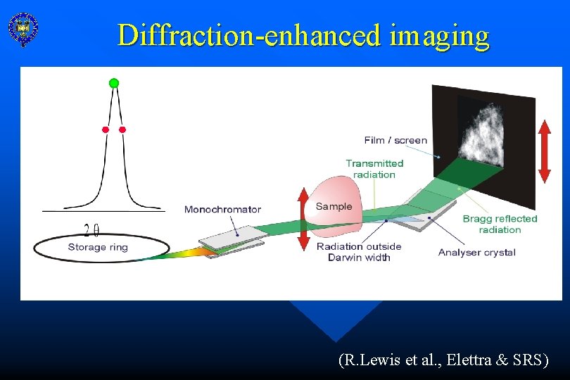 Diffraction-enhanced imaging (R. Lewis et al. , Elettra & SRS) 
