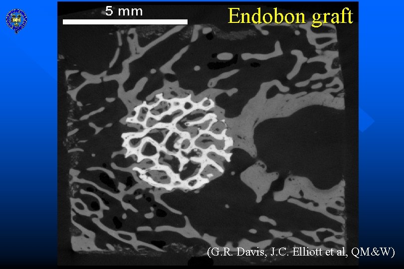 Endobon graft (G. R. Davis, J. C. Elliott et al, QM&W) 