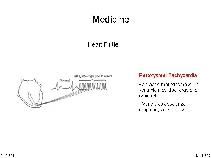 Medicine Heart Flutter Paroxysmal Tachycardia • An abnormal pacemaker in ventricle may discharge at