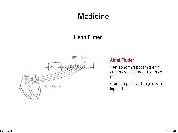 Medicine Heart Flutter Atrial Flutter • An abnormal pacemaker in atria may discharge at
