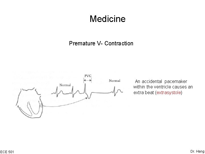 Medicine Premature V- Contraction An accidental pacemaker within the ventricle causes an extra beat