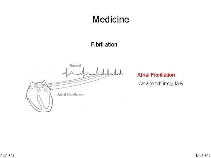 Medicine Fibrillation Atrial Fibrillation Atria twitch irregularly ECE 501 Dr. Hang 