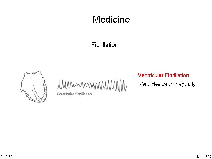 Medicine Fibrillation Ventricular Fibrillation Ventricles twitch irregularly ECE 501 Dr. Hang 
