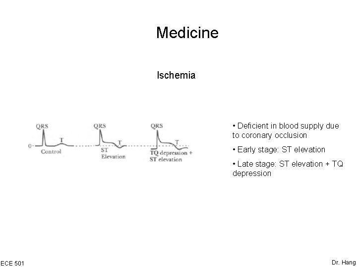 Medicine Ischemia • Deficient in blood supply due to coronary occlusion • Early stage: