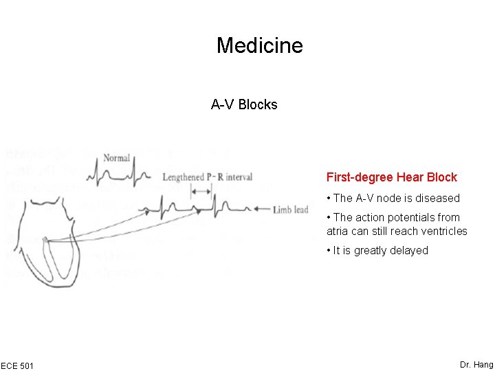 Medicine A-V Blocks First-degree Hear Block • The A-V node is diseased • The