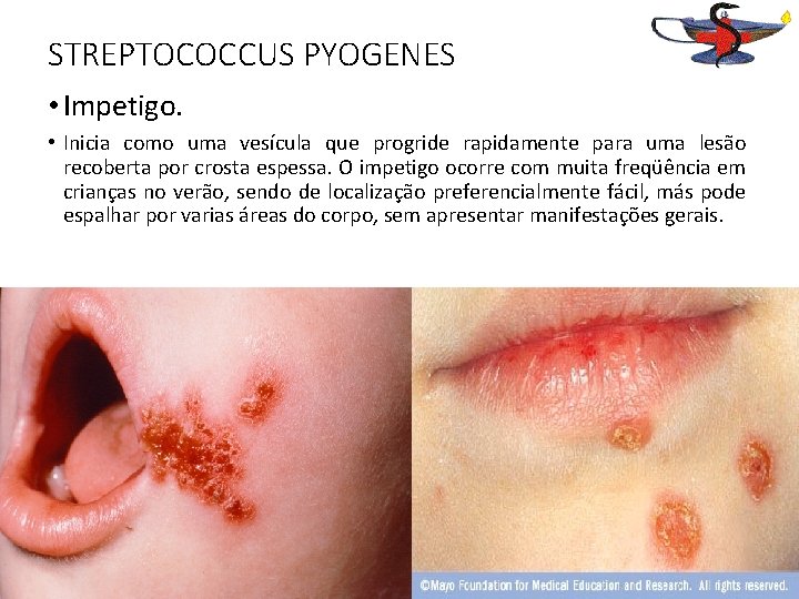 STREPTOCOCCUS PYOGENES • Impetigo. • Inicia como uma vesícula que progride rapidamente para uma