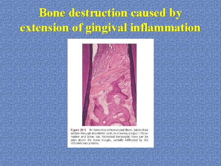 Bone destruction caused by extension of gingival inflammation 