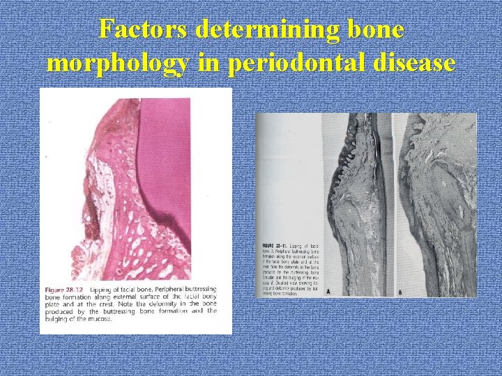 Factors determining bone morphology in periodontal disease 