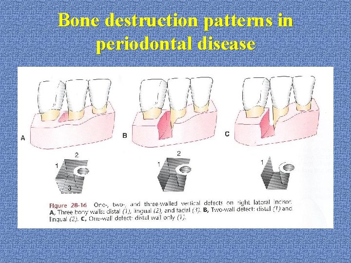 Bone destruction patterns in periodontal disease 