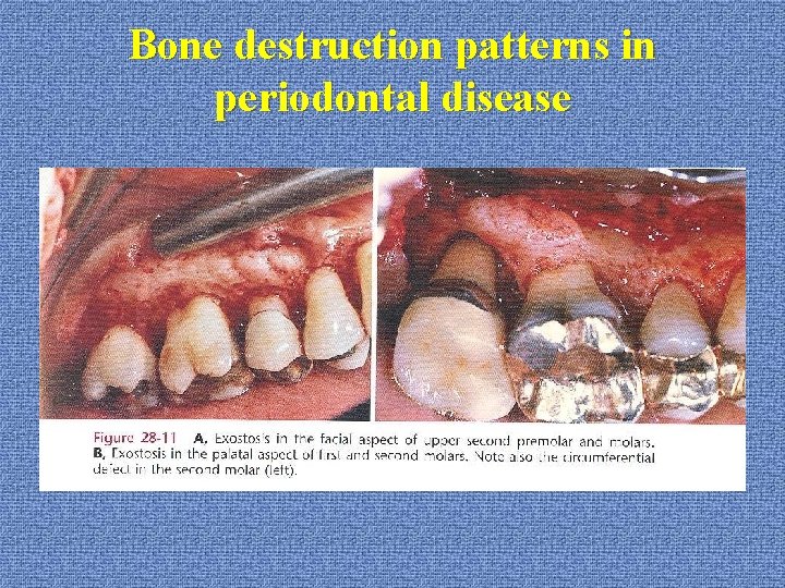 Bone destruction patterns in periodontal disease 