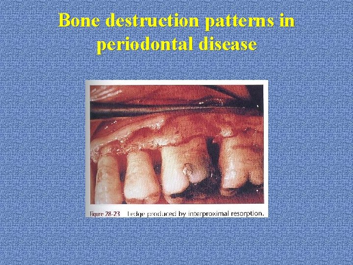 Bone destruction patterns in periodontal disease 