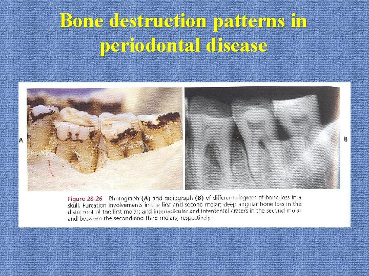 Bone destruction patterns in periodontal disease 