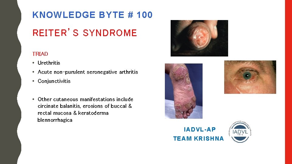 KNOWLEDGE BYTE # 100 REITER’S SYNDROME TRIAD • Urethritis • Acute non-purulent seronegative arthritis