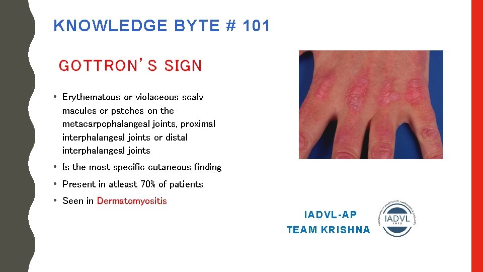 KNOWLEDGE BYTE # 101 GOTTRON’S SIGN • Erythematous or violaceous scaly macules or patches