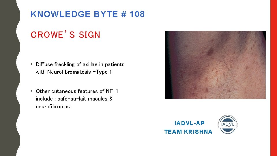 KNOWLEDGE BYTE # 108 CROWE’S SIGN • Diffuse freckling of axillae in patients with