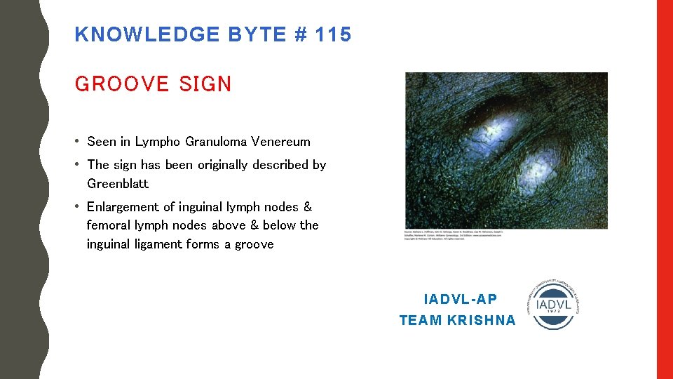KNOWLEDGE BYTE # 115 GROOVE SIGN • Seen in Lympho Granuloma Venereum • The