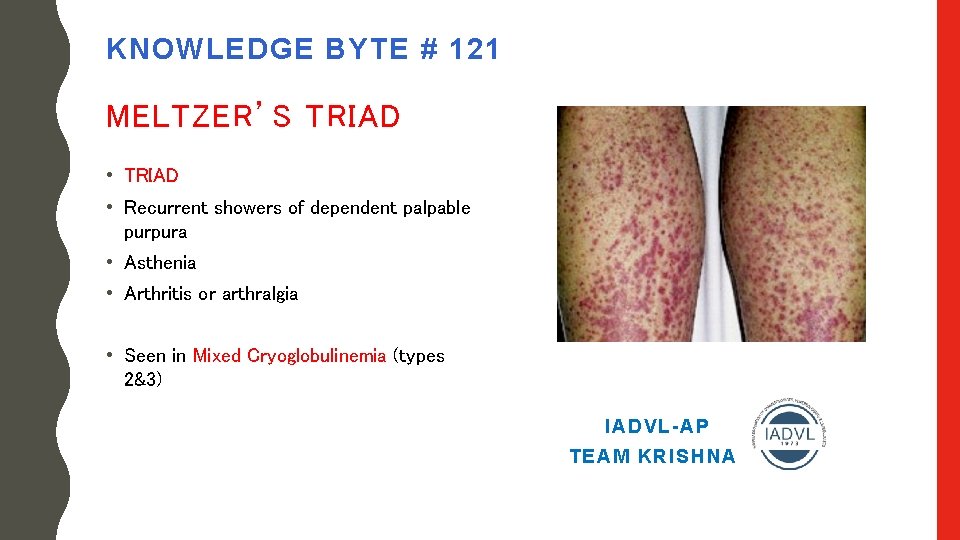 KNOWLEDGE BYTE # 121 MELTZER’S TRIAD • Recurrent showers of dependent palpable purpura •