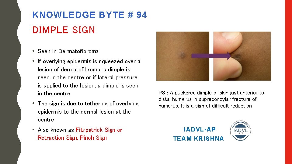 KNOWLEDGE BYTE # 94 DIMPLE SIGN • Seen in Dermatofibroma • If overlying epidermis