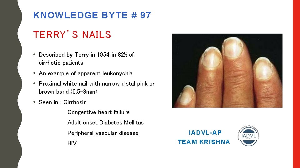 KNOWLEDGE BYTE # 97 TERRY’S NAILS • Described by Terry in 1954 in 82%