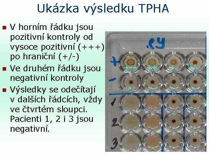 Ukázka výsledku TPHA n n n V horním řádku jsou pozitivní kontroly od vysoce