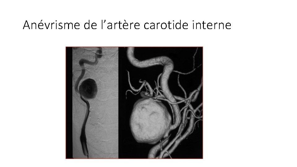 Anévrisme de l’artère carotide interne 