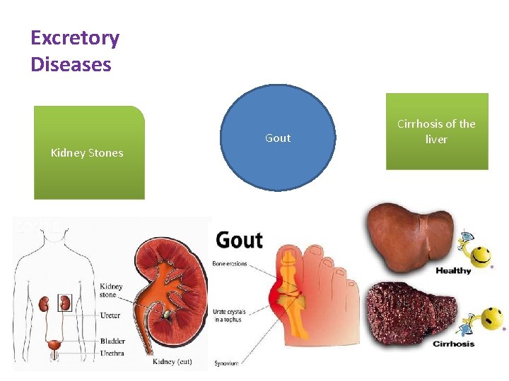 Excretory Diseases Kidney Stones Gout Cirrhosis of the liver 