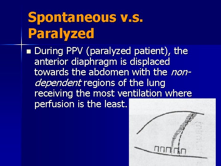 Spontaneous v. s. Paralyzed n During PPV (paralyzed patient), the anterior diaphragm is displaced