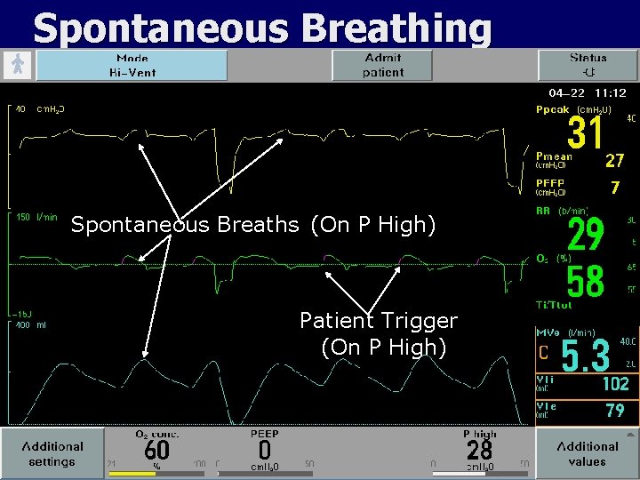 Spontaneous Breathing Spontaneous Breaths (On P High) Patient Trigger (On P High) 