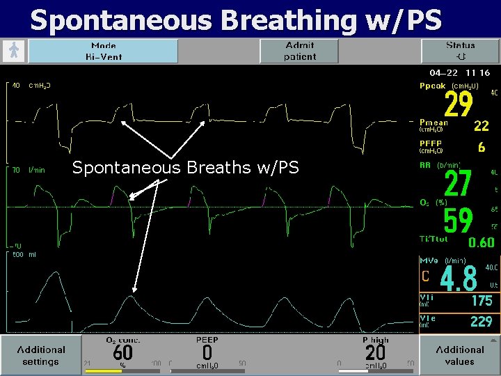 Spontaneous Breathing w/PS Spontaneous Breaths w/PS 