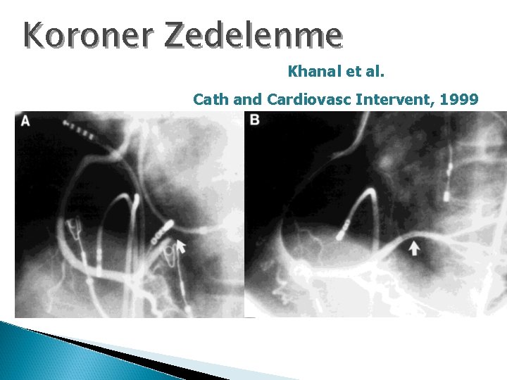 Koroner Zedelenme Khanal et al. Cath and Cardiovasc Intervent, 1999 