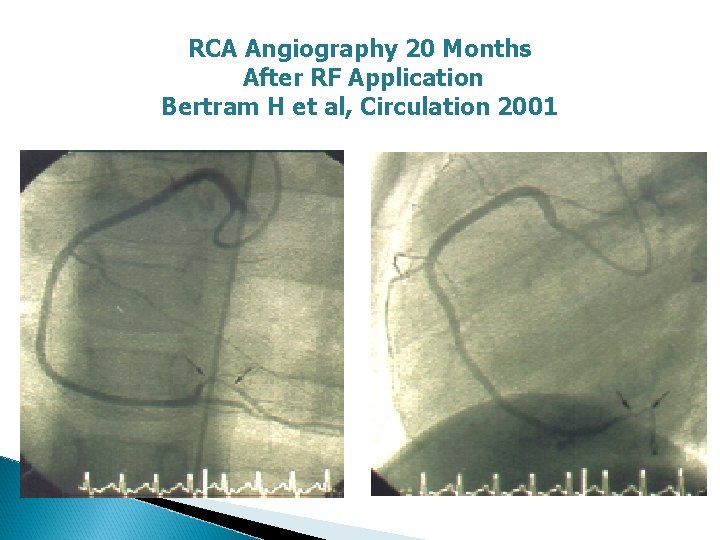 RCA Angiography 20 Months After RF Application Bertram H et al, Circulation 2001 