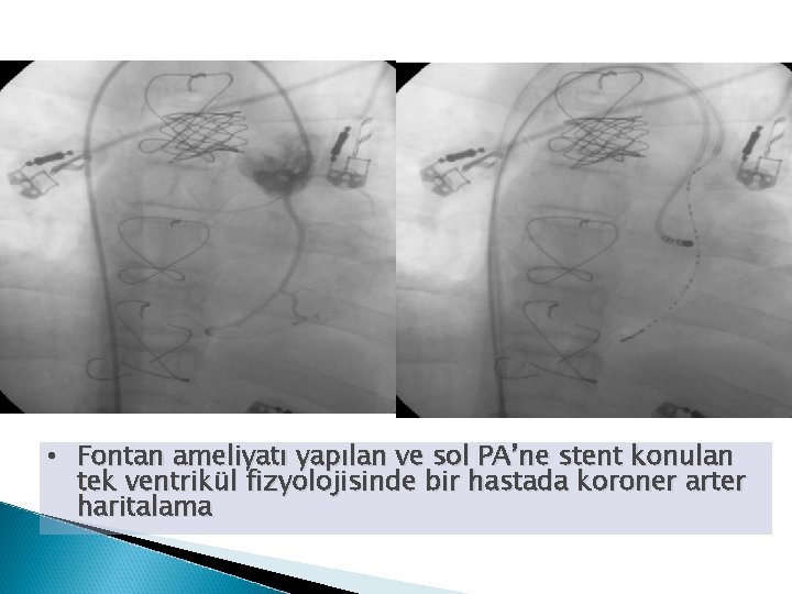  • Fontan ameliyatı yapılan ve sol PA’ne stent konulan tek ventrikül fizyolojisinde bir