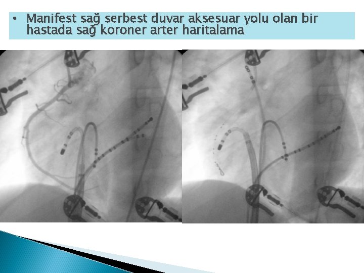 • Manifest sağ serbest duvar aksesuar yolu olan bir hastada sağ koroner arter