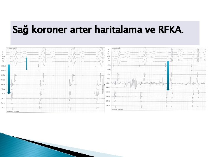 Sağ koroner arter haritalama ve RFKA. 