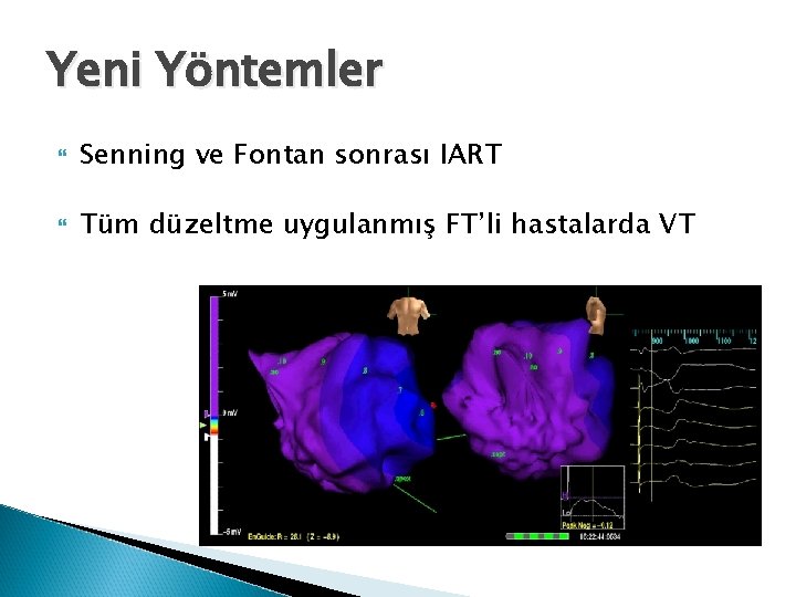 Yeni Yöntemler Senning ve Fontan sonrası IART Tüm düzeltme uygulanmış FT’li hastalarda VT 